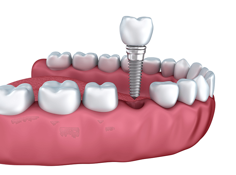 Implant single tooth